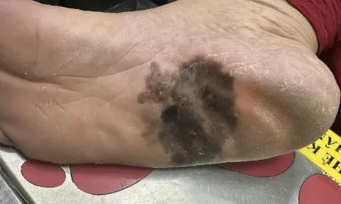 Đốm đen trên da có phải là dấu hiệu ung thư da?